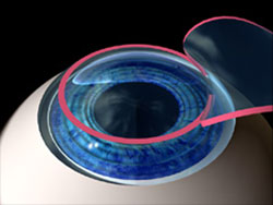 Treating astigmatism,
the cornea is made more spherical