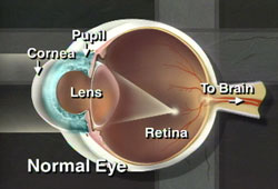 If there is a break or defect in the surface
layer of the cornea, a corneal ulcer results